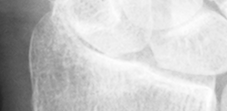 DistalRadius.bmp