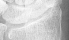 DistalRadius.bmp
