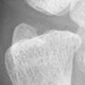 DistalUlna.bmp