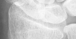DistalRadius.bmp