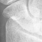 Scaphoid.bmp