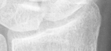 DistalRadius.bmp