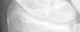 DistalRadius.bmp